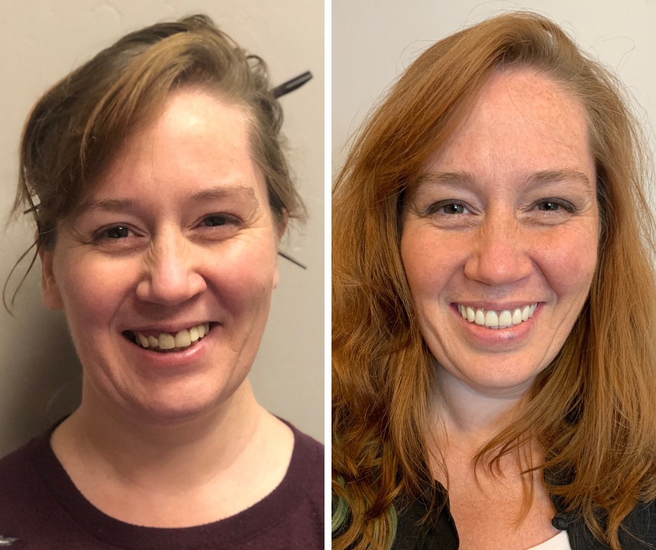 Before and after All-on-X dental implants