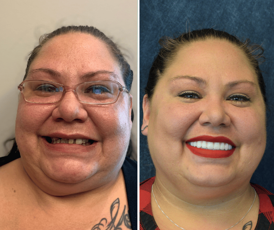 Before and after All-on-X dental implants