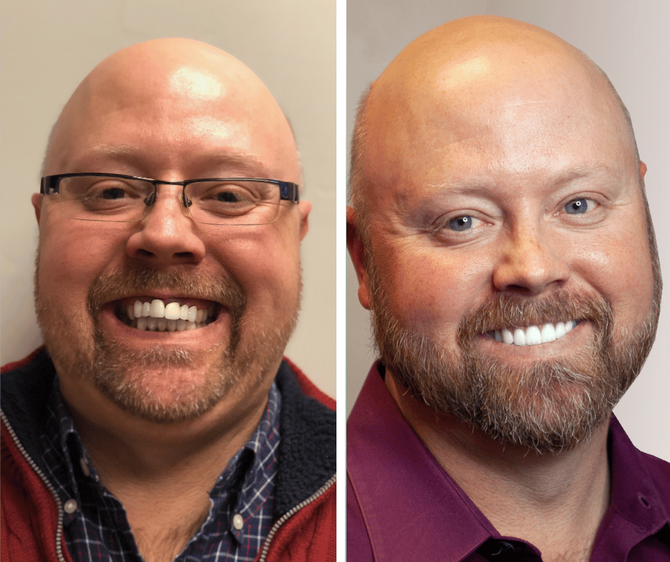 Before and after All-on-X dental implants