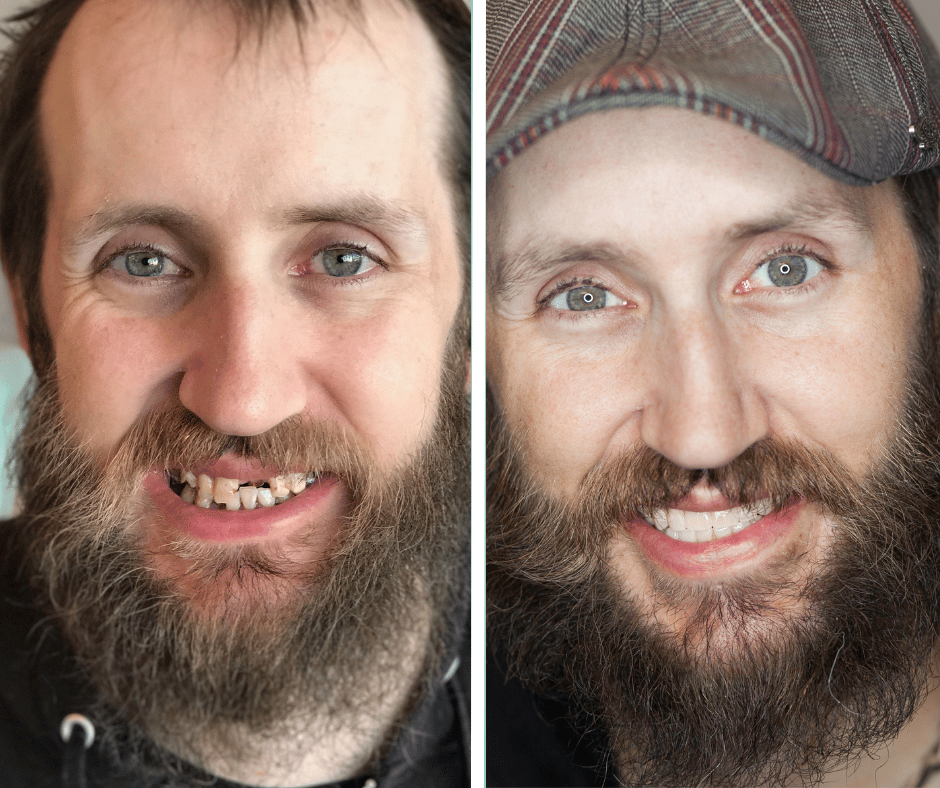 Before and after All-on-X dental implants