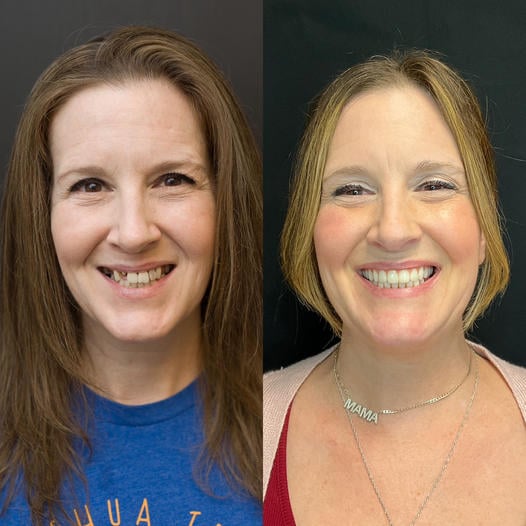 Before and after All-on-X dental implants
