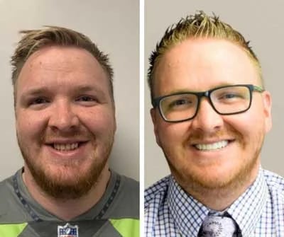 Before and after All-on-X dental implants