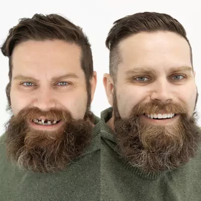 Stubbs Dental Before and After Dental Implants