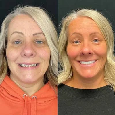 Before and after All-on-X dental implants