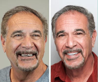 Before and after All-on-X dental implants