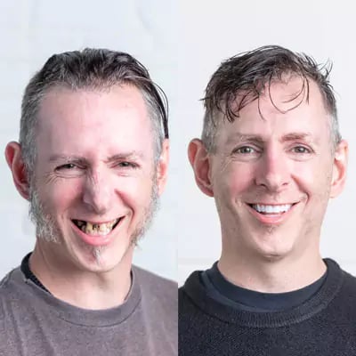 Before and after All-on-X dental implants