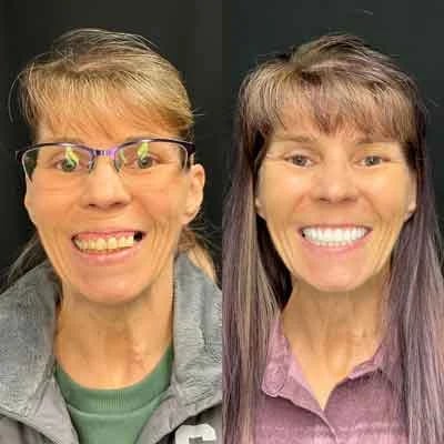 Before and after All-on-X dental implants