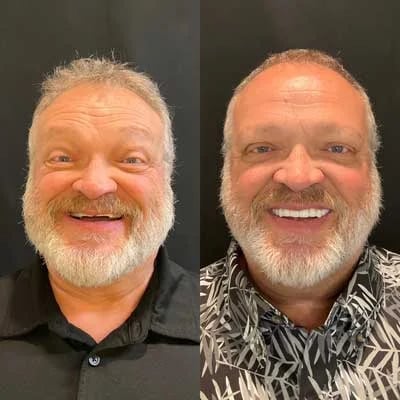 Before and after All-on-X dental implants