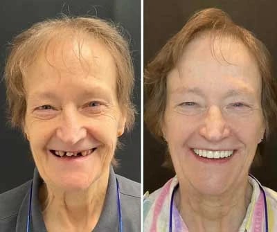 Before and after All-on-X dental implants