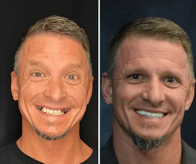 Before and after All-on-X dental implants