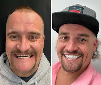 Before and after All-on-X dental implants